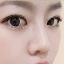 Kết quả phẫu thuật mũi 3