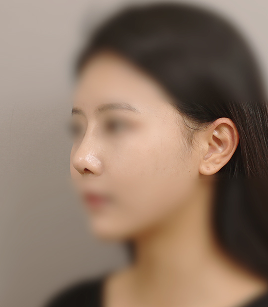 Hình ảnh sau khi thẩm mỹ mũi 1