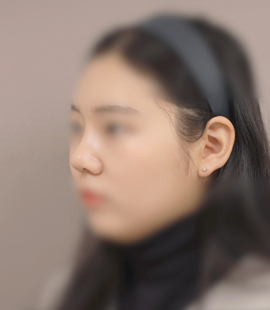 Hình ảnh sau khi thẩm mỹ mũi 2