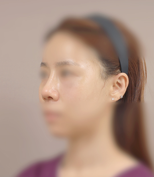 Hình ảnh sau khi thẩm mỹ mũi 3