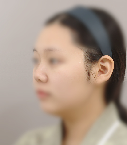 Hình ảnh trước khi thẩm mỹ mũi 2