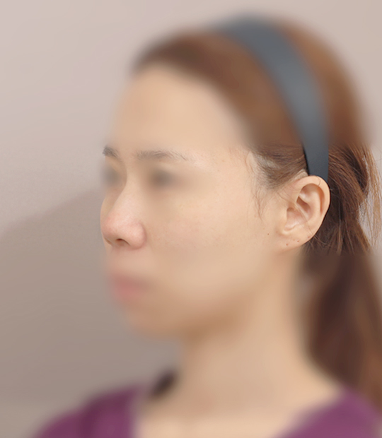 Hình ảnh trước khi thẩm mỹ mũi 3