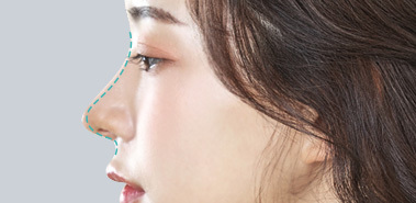 Lý do và phương pháp điều trị của phẫu thuật sửa mũi 2