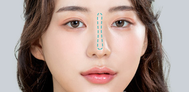 Lý do và phương pháp điều trị của phẫu thuật sửa mũi 5