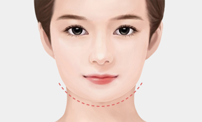 Nếu cần phải phẫu thuật chỉnh sửa hàm vuông của Phẫu thuật thẩm mỹ Gangnam Hospital No. 1 - 1