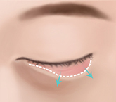 Phương pháp Mổ bọng mỡ dưới mắt 2