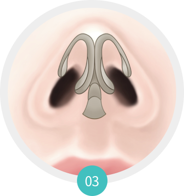 Phương pháp phẫu thuật mũi gồ 3