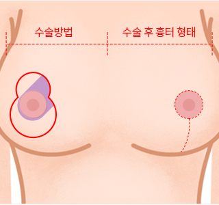 Phương pháp phẫu thuật thu nhỏ ngực 1