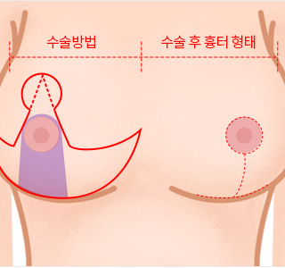 Phương pháp phẫu thuật thu nhỏ ngực 2