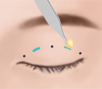 Phương Pháp Treo cơ mí mắt 2