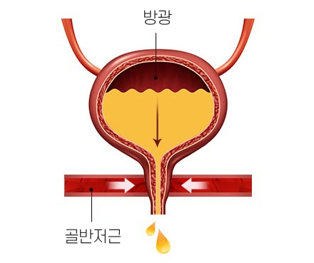 Trường hợp tiểu không tự chủ
